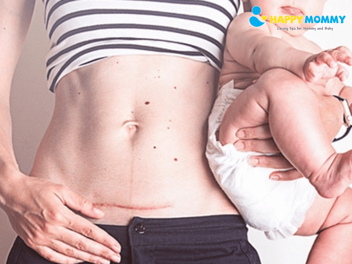 cham-soc-vet-mo-sau-sinh