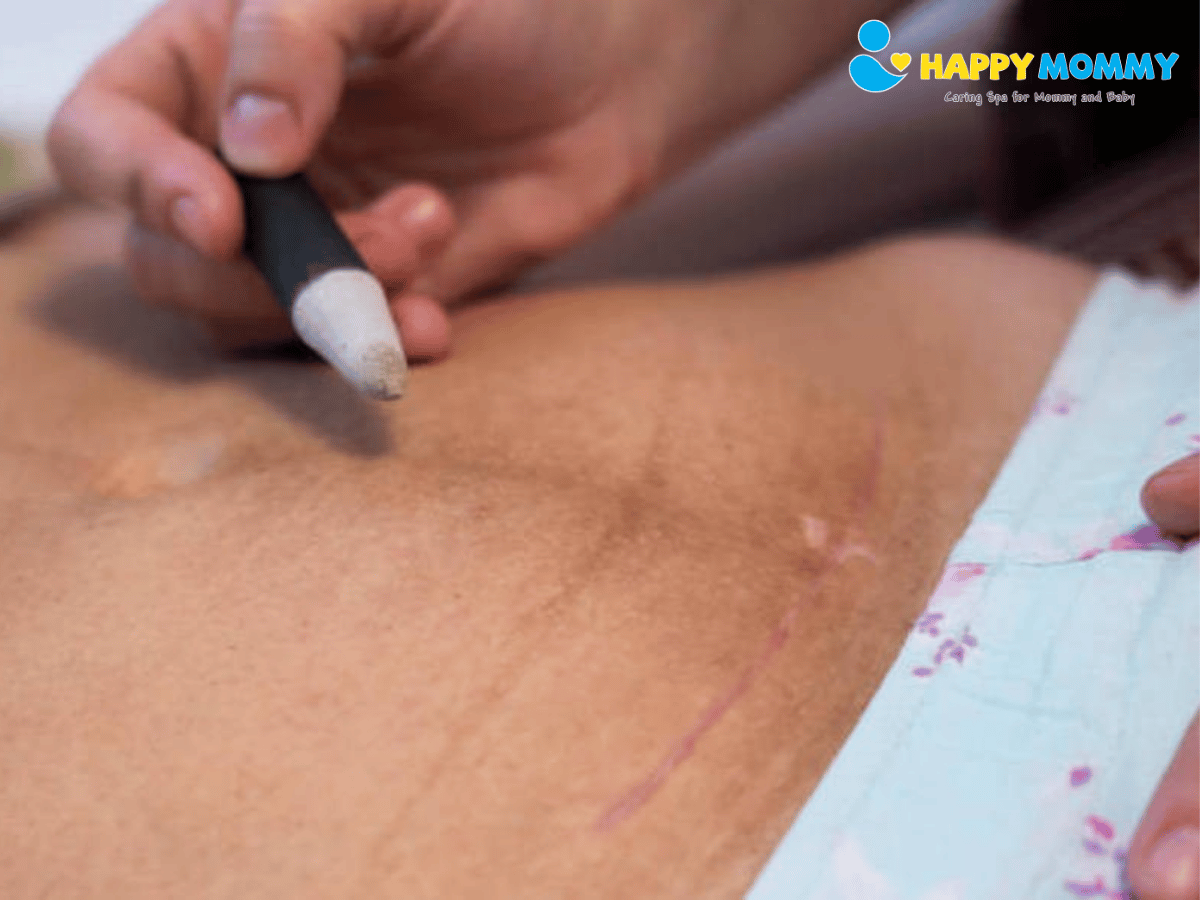 cham-soc-vet-mo-sau-sinh