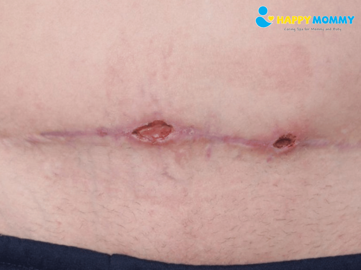 cham-soc-vet-mo-sau-sinh